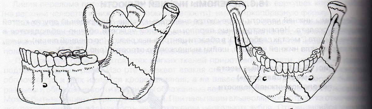 Переломы нижней челюсти стоматология презентация