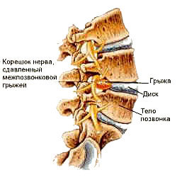 Здоровье позвоночника 4 - Ода, Гигена позвоночника, Межпозвоночная грыжа, Протрузия, Длиннопост
