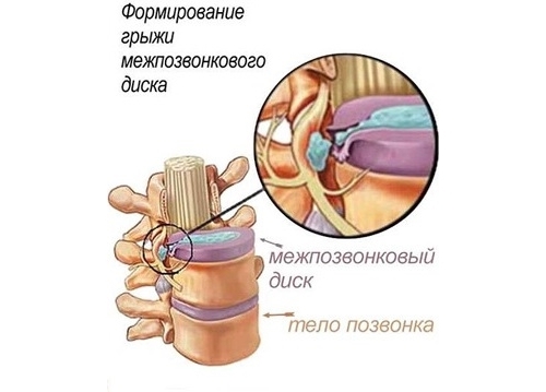 Здоровье позвоночника 4 - Ода, Гигена позвоночника, Межпозвоночная грыжа, Протрузия, Длиннопост