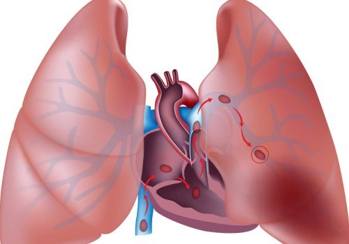 Acute thromboses - My, The medicine, Thrombosis, Thela, Diagnostics, For erudition, Longpost