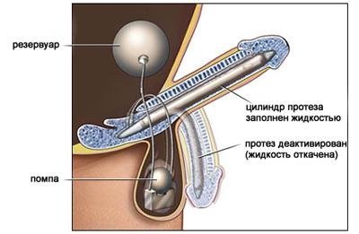 Inflatable prostheses - Impotence, The medicine, NSFW, Prosthetics, Erection