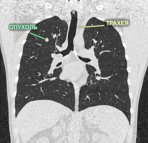 Что в легком? - Моё, Хирургия, Опухоль, Торакальная хирургия, Длиннопост