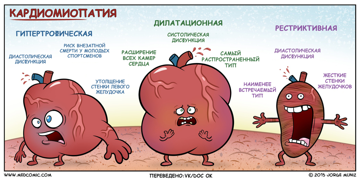 Кардиопатия сердца. При дилатационной кардиомиопатии отмечается:. Кардиомиопатии дилатационная гипертрофическая рестриктивная. Кардиомиопатия сердца.