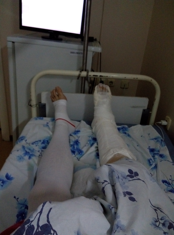 Walked, fell, cast and hospital for the new year, part 3 - My, Hospital, Fracture, New Year, Longpost