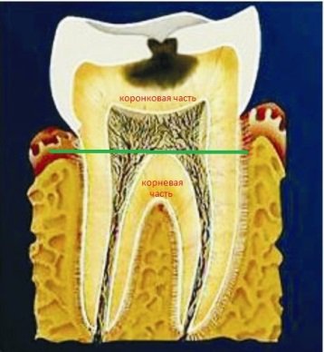 Dental caries and how to deal with it - My, Caries, , Cause of caries, Teeth, Streptococcus