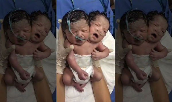 Two-headed mutant boy born in Mexico - Mexico, Oddities, Mutant, Country, news, Boy, 2017, Doctors