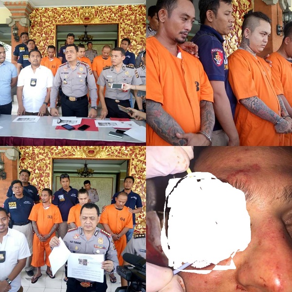 In continuation of the post about a tourist whose eye was gouged out by security. - Bali, Fight, Lawlessness