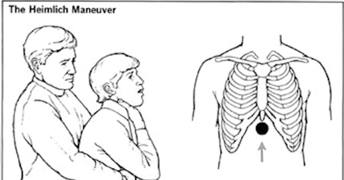 Геймлих. Генрих Геймлих. Геймлих әдісі. Маневр Геймлиха самому. Маневр Хаймлиха как делать.