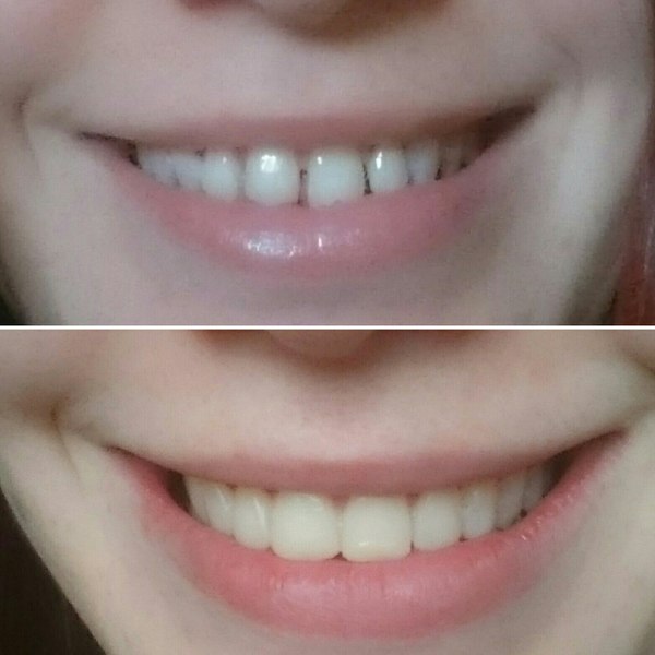 Veneers 5. Half a million smile. Photos! - My, Veneers, Teeth, Dentist, Dentistry, Text, Longpost, beauty