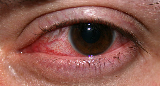 почему от марихуаны красные глаза