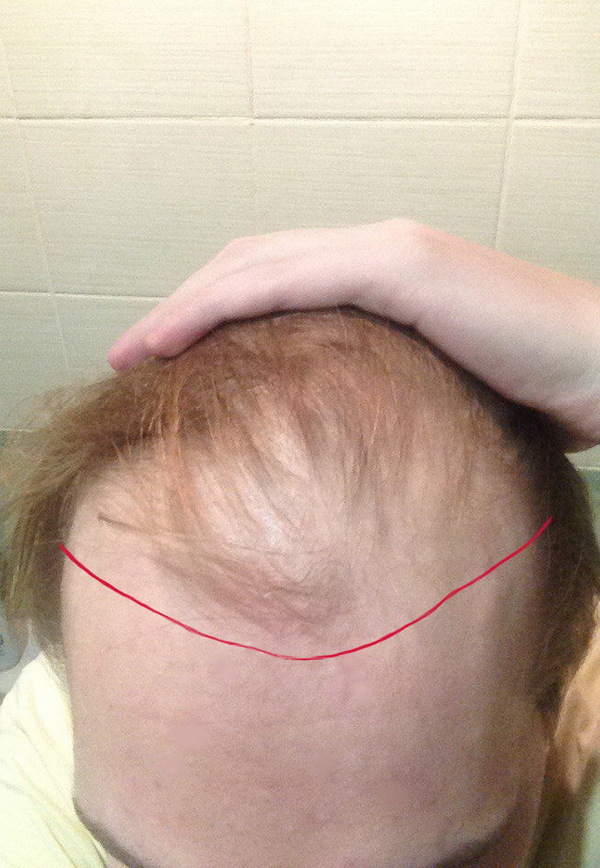 How I did a hair transplant and the result after 3.5 months. - , Method for baldness, Baldness, Hair Transplant, Transfer, My, Longpost