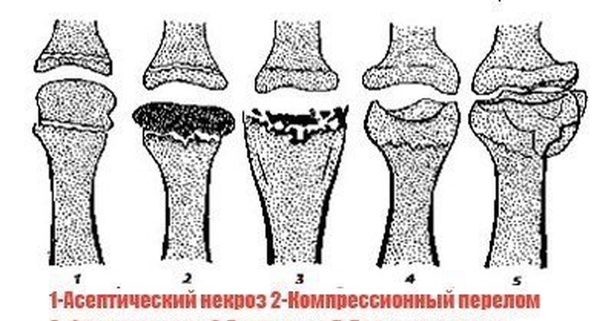 Остеохондропатии - причины, симптомы, диагностика и лечение ✓ Клиника доктора Симкина