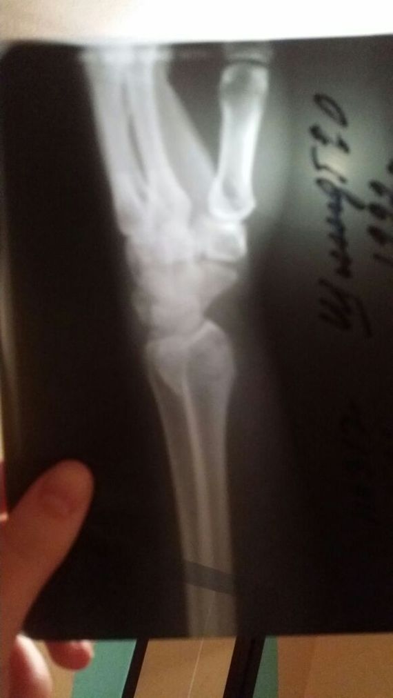 Guessing. Where is the fracture? - My, Longpost, Mystery, Traumatology, The medicine, Broken arm