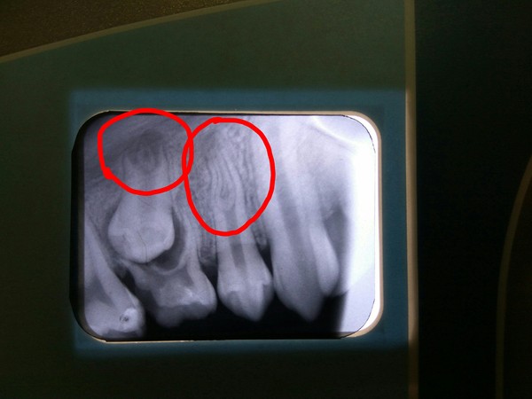 teeth in teeth - My, Teeth, Dentistry, Anomaly, Work