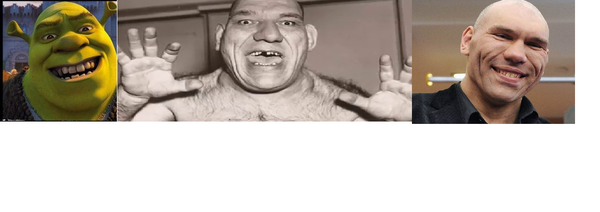 Болезнь акромегалия