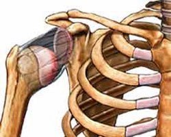 Chronic shoulder instability - The medicine, Disease, Pathology, Joints, Longpost