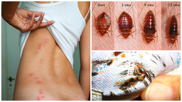 Bedbugs poisoning our lives and not only - Images, Longpost, Bedbugs, Health, Disease