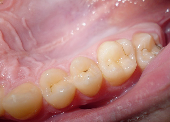 Simple Dentistry. Caries. - , Longpost, The medicine, Facts, Images, Dentistry, The science