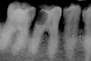 Simple Dentistry. Caries. - , Longpost, The medicine, Facts, Images, Dentistry, The science