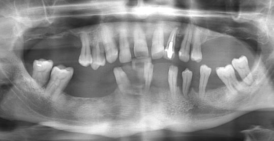 Simple Dentistry. Caries. - , Longpost, The medicine, Facts, Images, Dentistry, The science