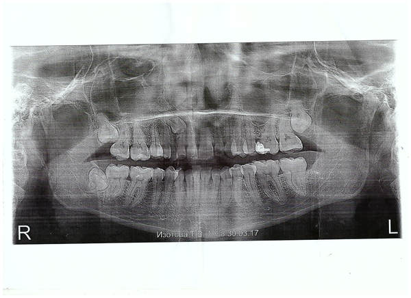 To be or not to be? - My, Wisdom tooth, Extraction of teeth, Disgusting eight