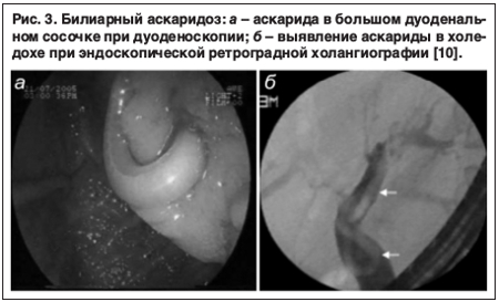 Ascariasis in children - The medicine, Ascariasis, Disease, Roundworm, Images, Text, Longpost