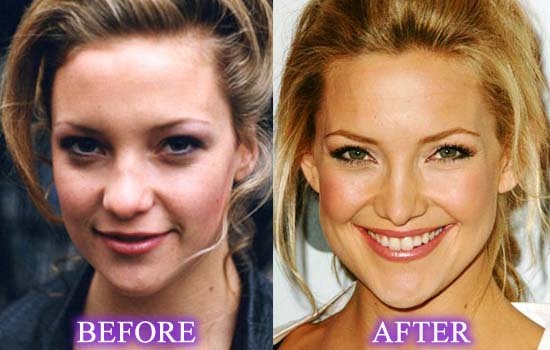 Celebrities who have had plastic surgery - Stars, Celebrities, Hollywood, Plastic, Interesting, Article, It Was-It Was, Longpost