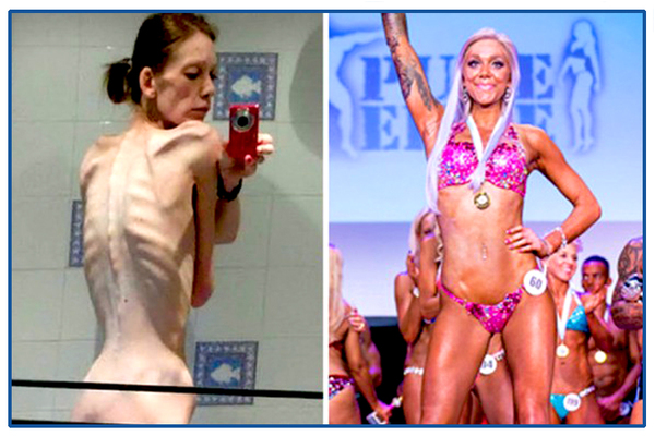 The girl was saved from death by bodybuilding. - Girls, Anorexia, Facts, Body-building, news