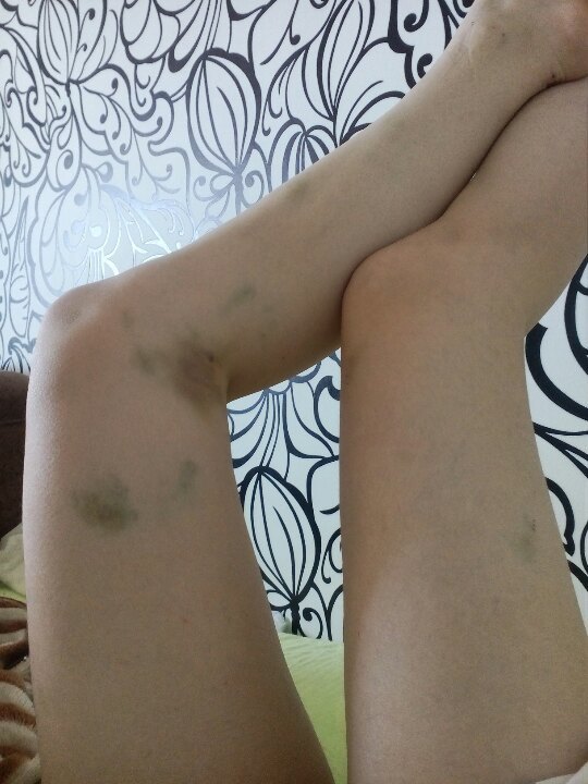 First time. - My, First time, A bike, Cyclist, Accident, Legs, Bruise, Sadism, beauty