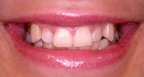 Need dental advice - Teeth, Dentistry, 