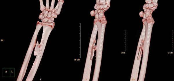 Living with a foreign body for 5 years (without knowing it) - My, Rustograph, Rustomograf, Tomography, CT, Glass, The medicine, Injury