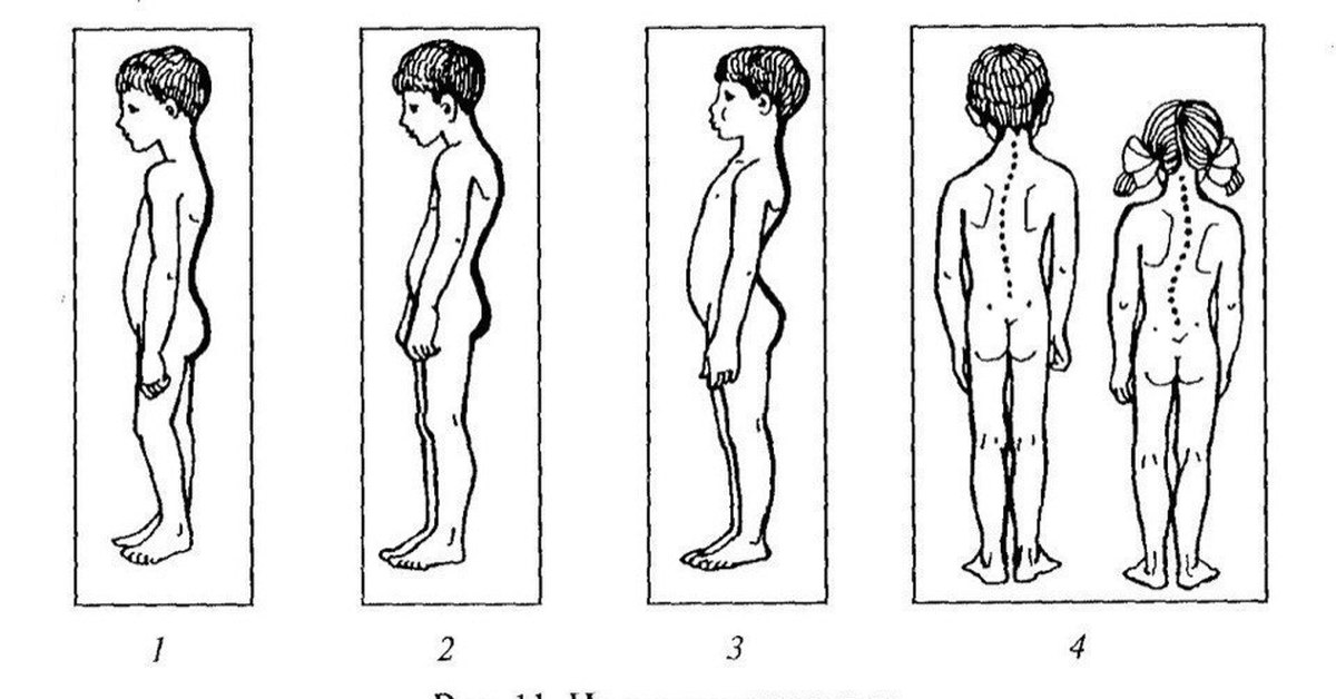 1 4 виды детей. Виды нарушения осанки у детей. Типы нарушений осанки сутулость. Нарушение осанки, искривление позвоночника. Причины формирования неправильной осанки у детей.