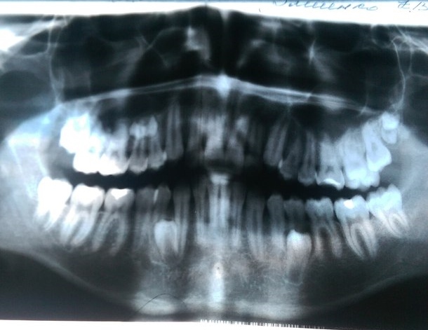 Sharkboy or teeth problems - My, Teeth, , Dentistry, Mutant, Monster, Longpost