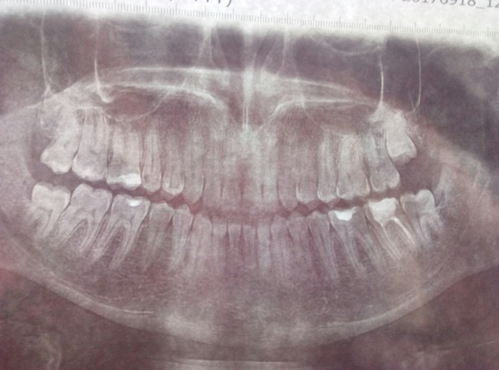 Wisdom Tooth or Hateful Eight - My, Dentist, Disgusting eight, Teeth, Wisdom tooth, Suffering, Pain