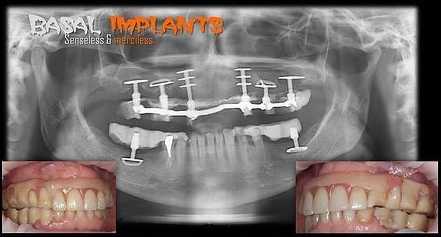 Basal implantation or ALDP* - My, Dentistry, Implantation, Teeth, Longpost