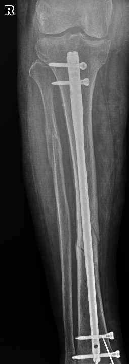 From the life of a radiologist. Part 1. - My, Radiology, Sos, Osteosynthesis, Longpost, The medicine