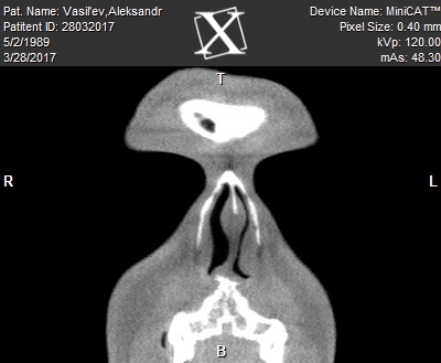 Surgery to correct the nasal septum... - My, Operation, Kazakhstan, Almaty, Hospital, Partitions, Longpost