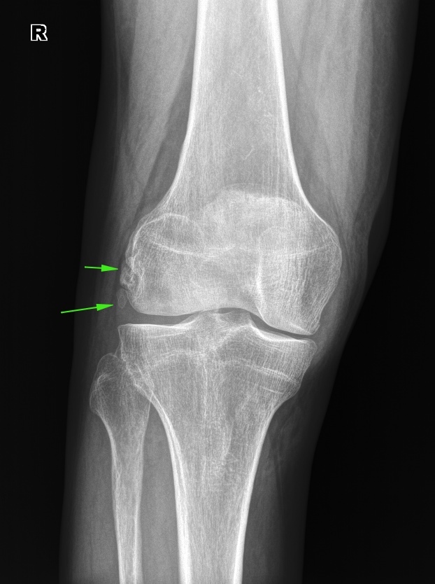 Трещина в коленной. Перелом мыщелков бедренной кости рентген. Перелом мыщелка бедренной кости рентген. Краевой перелом медиального мыщелка бедренной кости рентген. Перелом наружного мыщелка большеберцовой кости рентген.