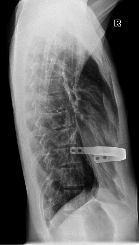 From the life of a radiologist. Part 15 - My, X-ray, The medicine, Fracture, Necrosis, Stump, Longpost