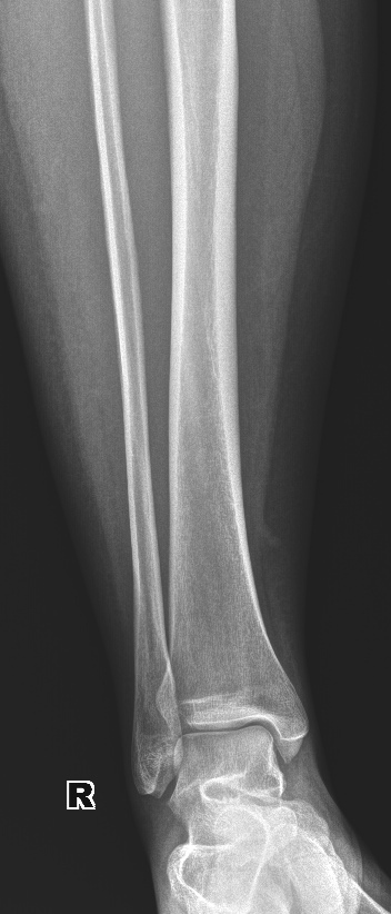 From the life of a radiologist. Part 16 - My, X-ray, The medicine, Fracture, Diverticulitis, Pneumothorax, Hydrothorax, Scoliosis, Longpost