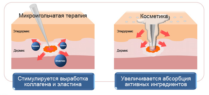 Mesoscooter (microneedle therapy) - Mezoroller, Female beauty, beauty