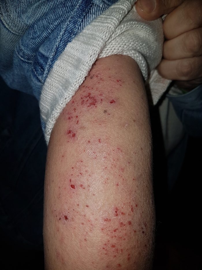 Дерматология. Подскажите пожалуйста Медицина, Кожа, Здоровье, Длиннопост, Помощь