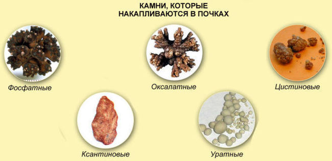 On a small urolithic wave. - Icd, Urolithiasis disease, Stones in the kidneys, Pain, Longpost