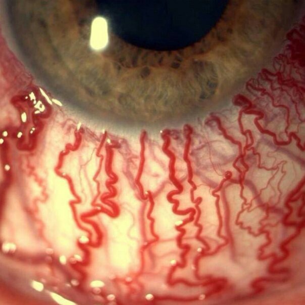 The eye of a drug addict in macro photography - The medicine, The photo, Macro photography, Eyes, Addiction