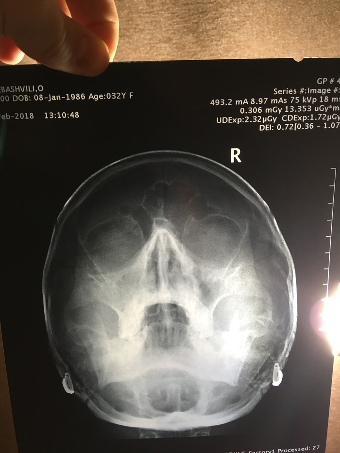 What is visible in the picture? - The medicine, Doctors, My, Selfie, X-ray, Sinusitis