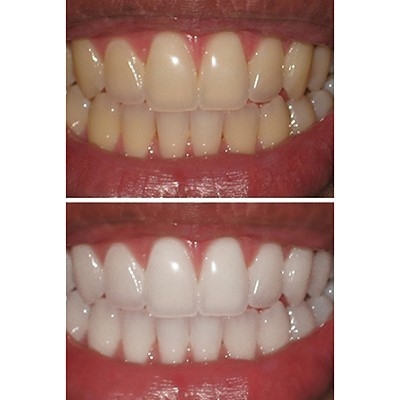 Teeth whitening - My, Dentistry, Teeth whitening, Longpost