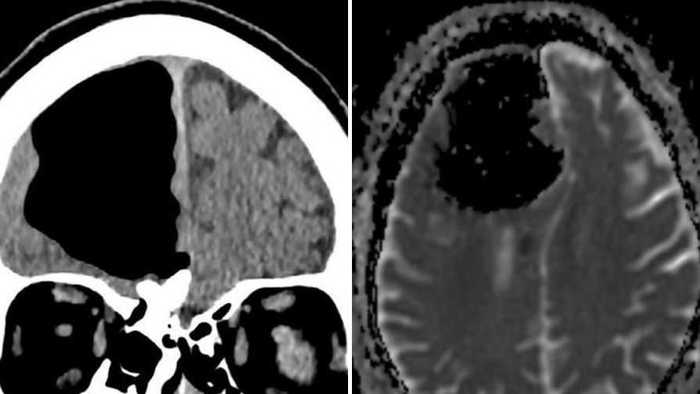 Воздух в черепе на месте мозга Медицина, МРТ, опухоль, череп, воздух, мозг