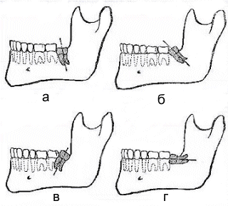 The Hateful Eight. My experience - My, Disgusting eight, Dentistry, Surgery, Extraction of teeth, Paid medicine, Longpost