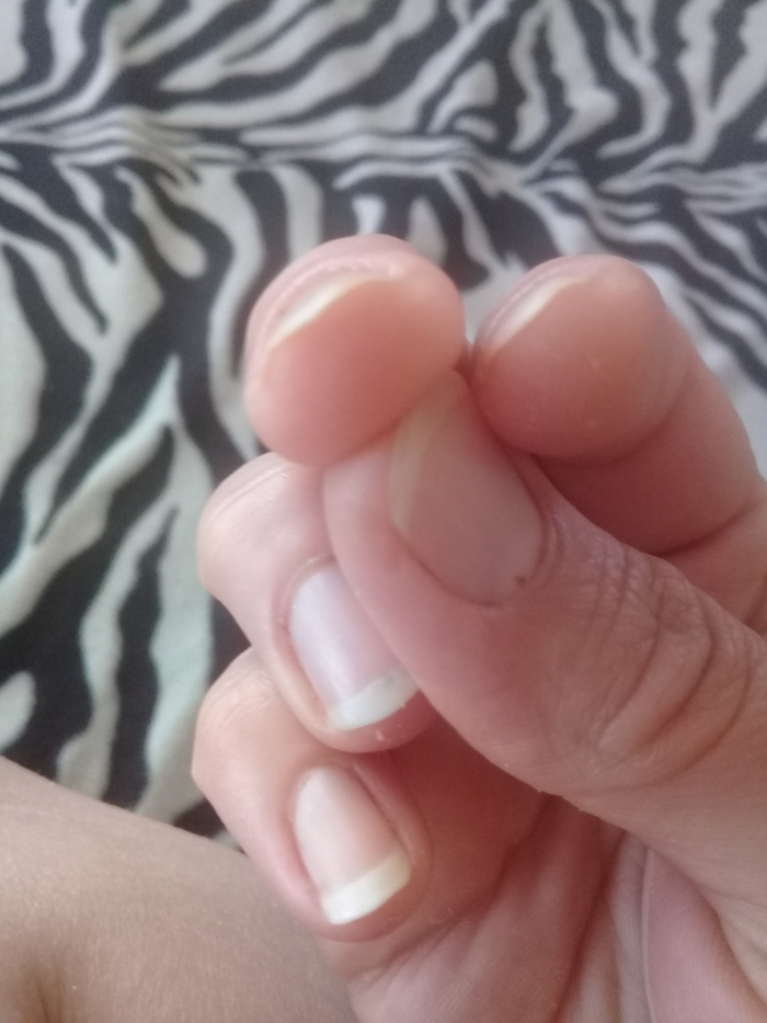 Need help. - Nails, My, No rating, Longpost, Dermatology