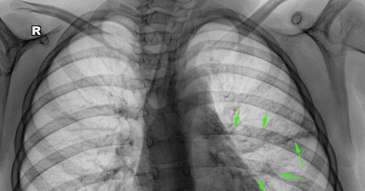 Рентген легких с пневмонией фото у детей